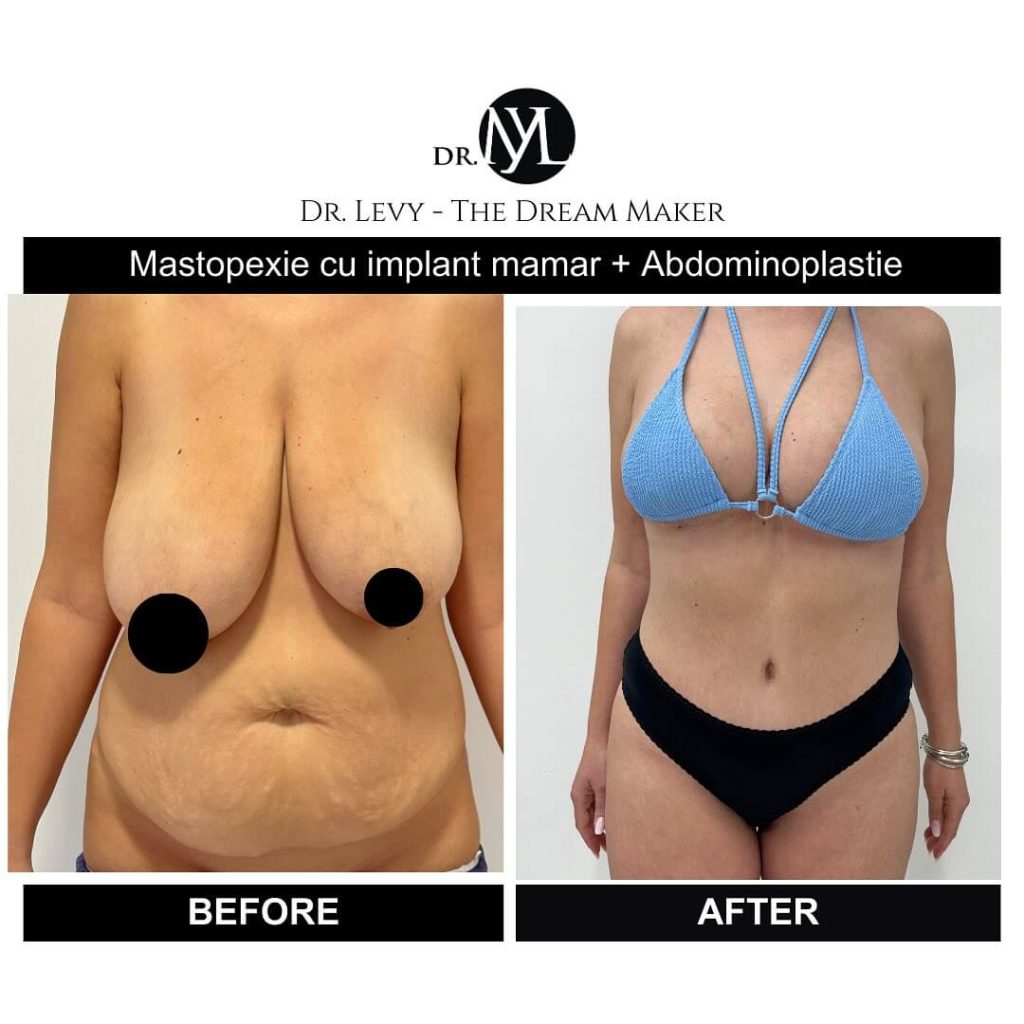 poza burta abdominoplastie