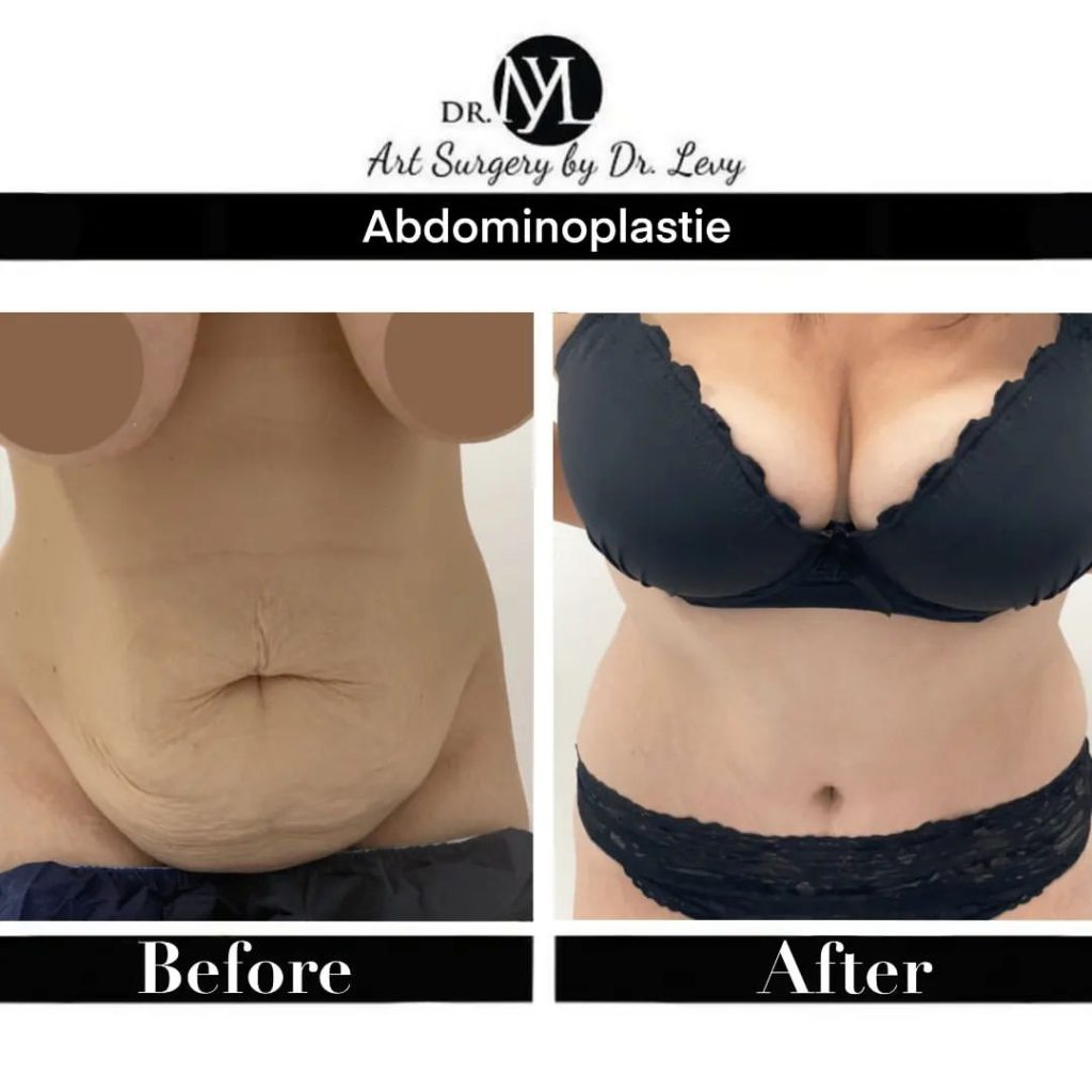pret operatie abdominoplastie