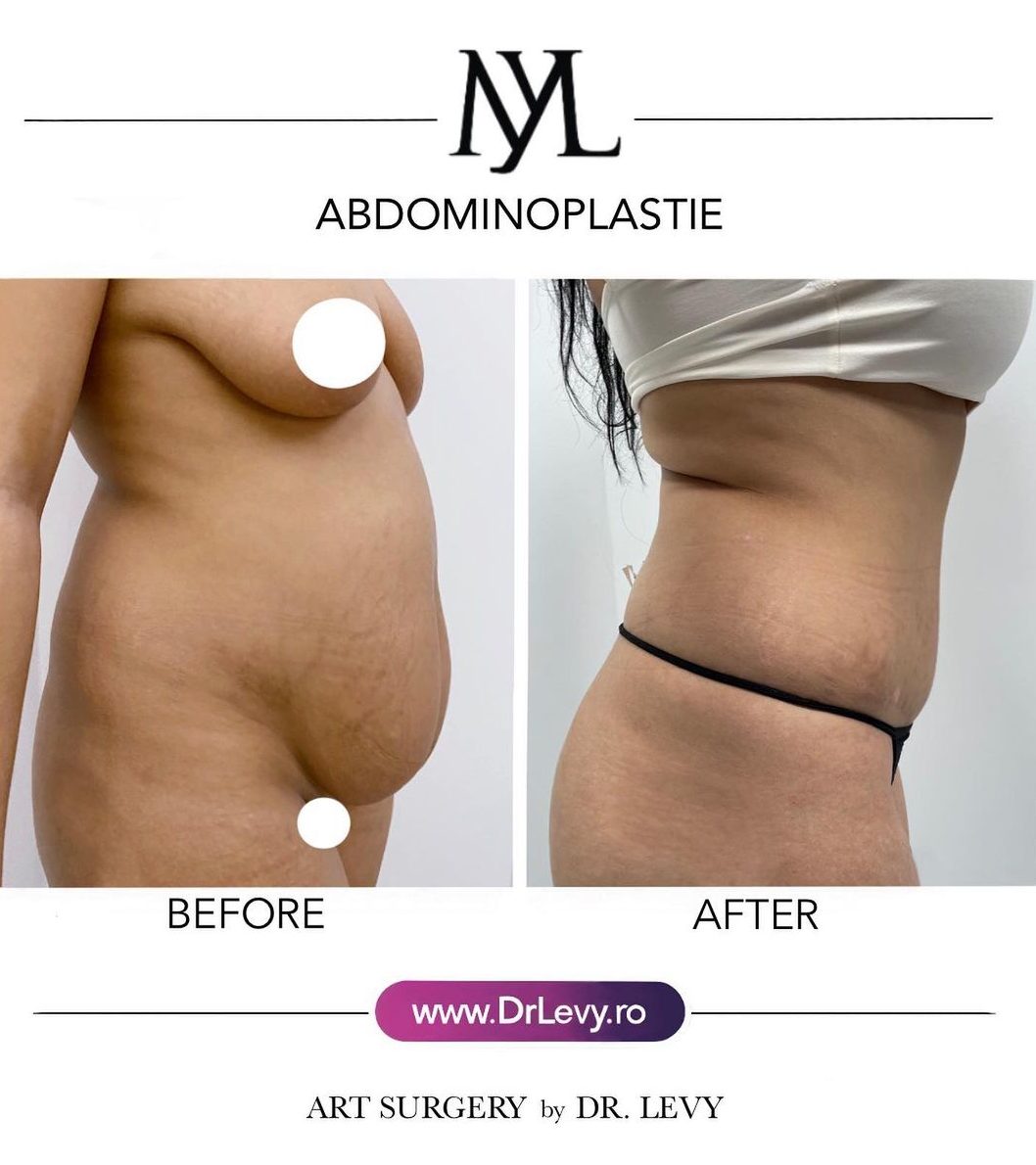 imagini rezultat abdominoplastie