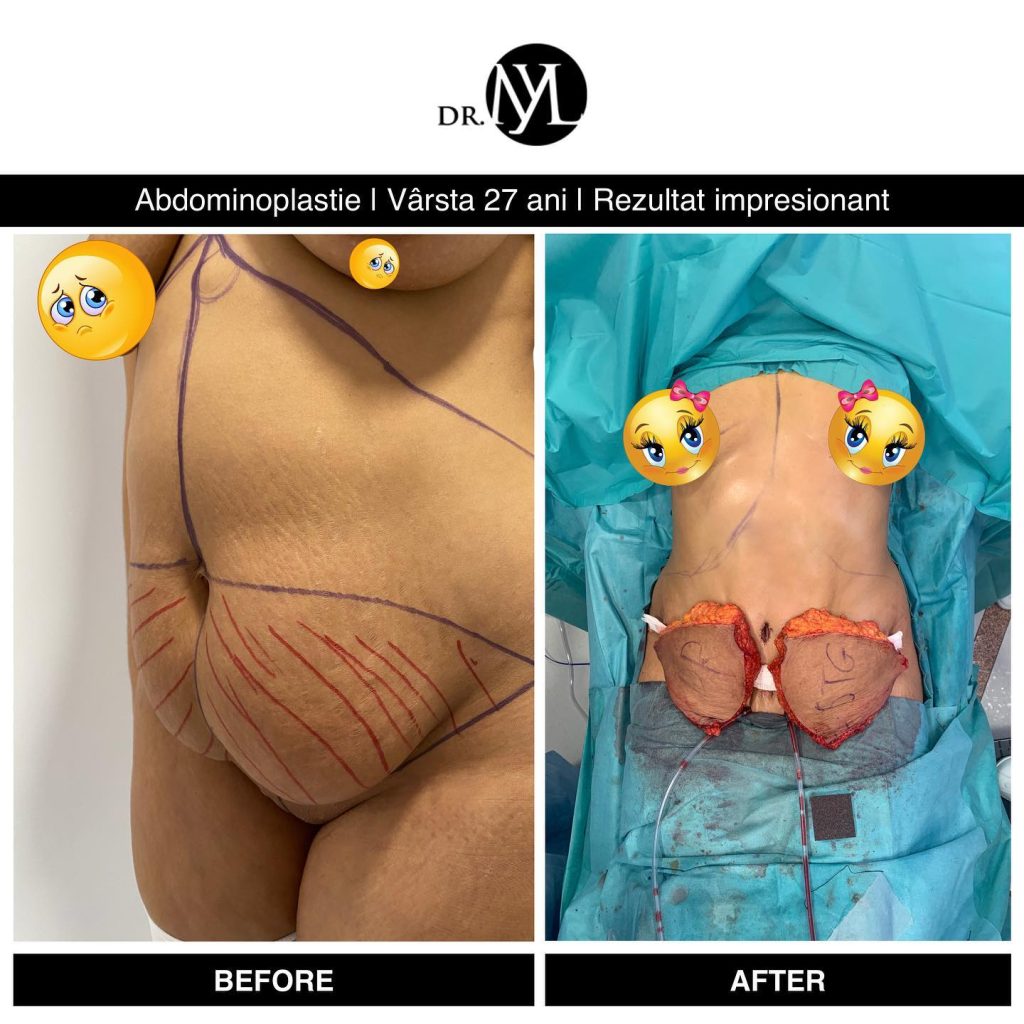 operatie abdominoplastie