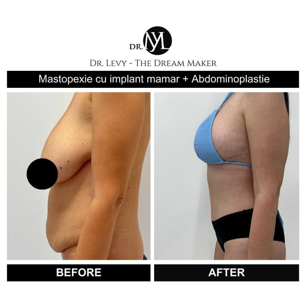 poza inainte si dupa abdominoplastie