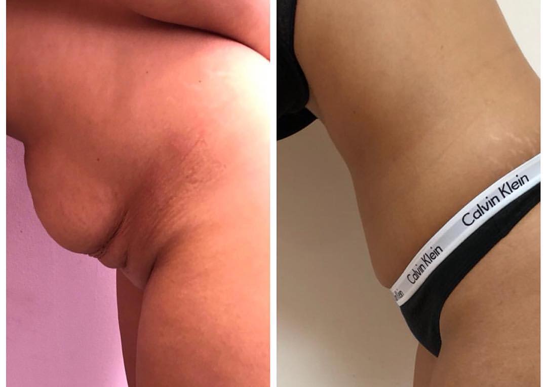 poza inainte si dupa abdominoplastie