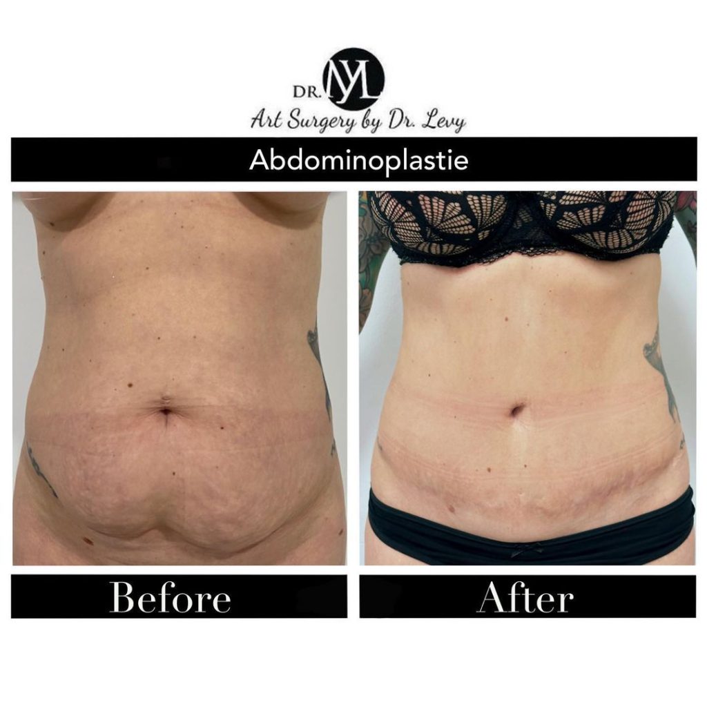 operatie abdominoplastie