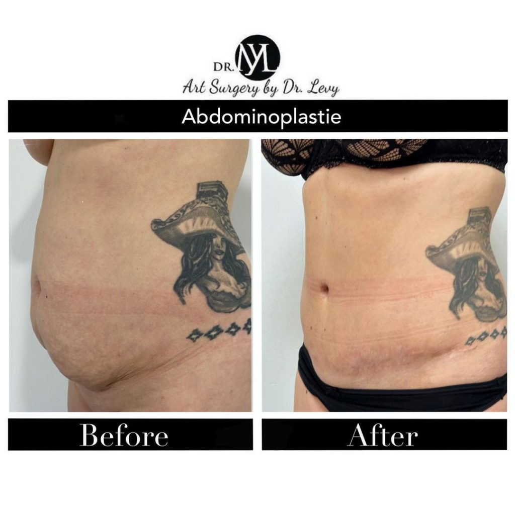 exces de piele abdominal