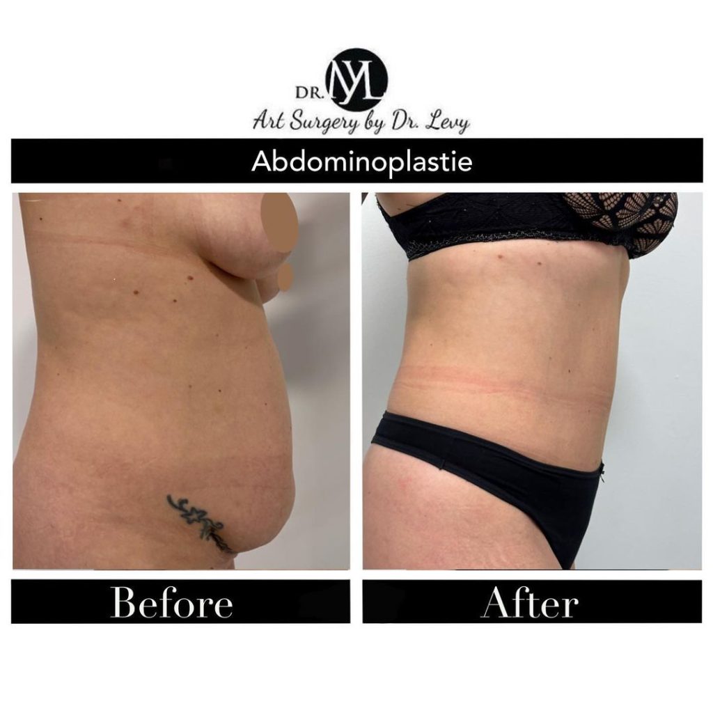 piele lasata pe burta, abdomen