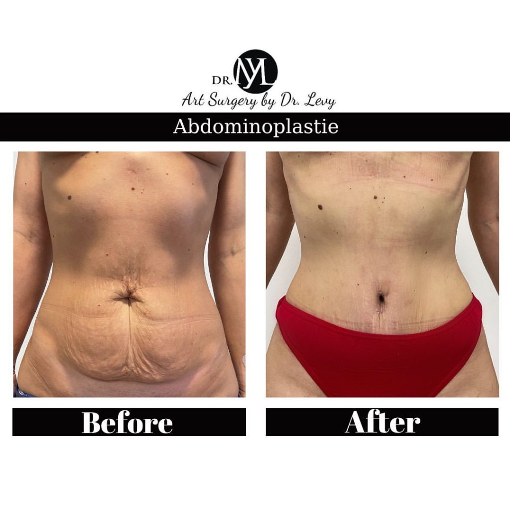 operatie exces de piele burta