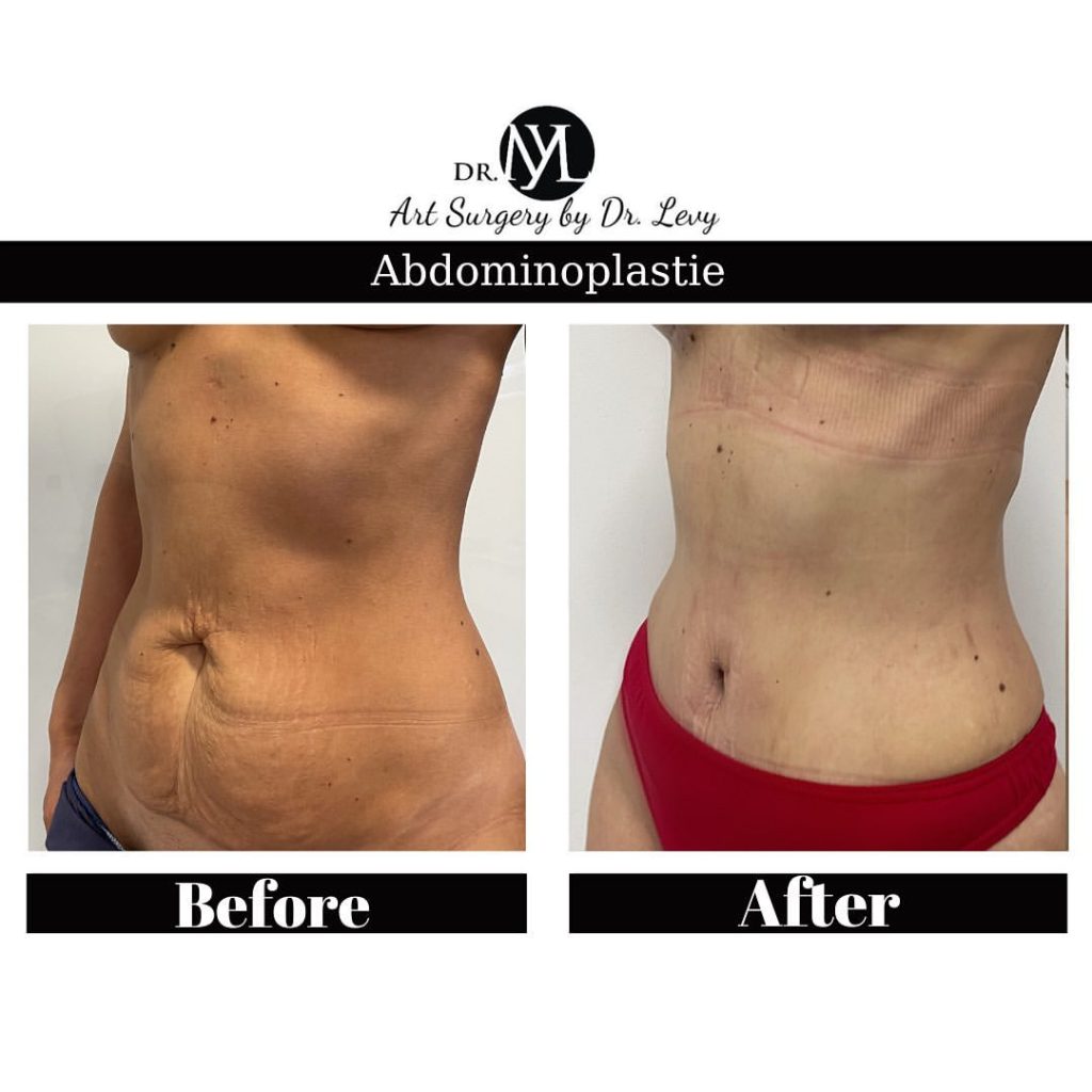 operatie abdominoplastie romania